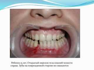 Деформации нижней челюсти