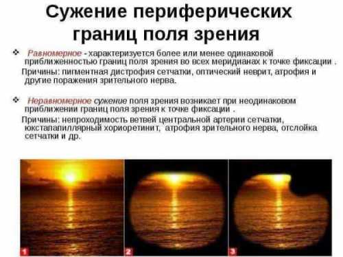 Инвалид по зрению: определение инвалидности (сколько диоптрий), при каком дают, как получить группу 1, 2, 3, когда один глаз не видит