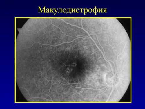 Оценка ограничений зрения