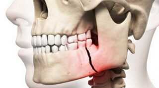 Пострезекционные аномалии верхней челюсти